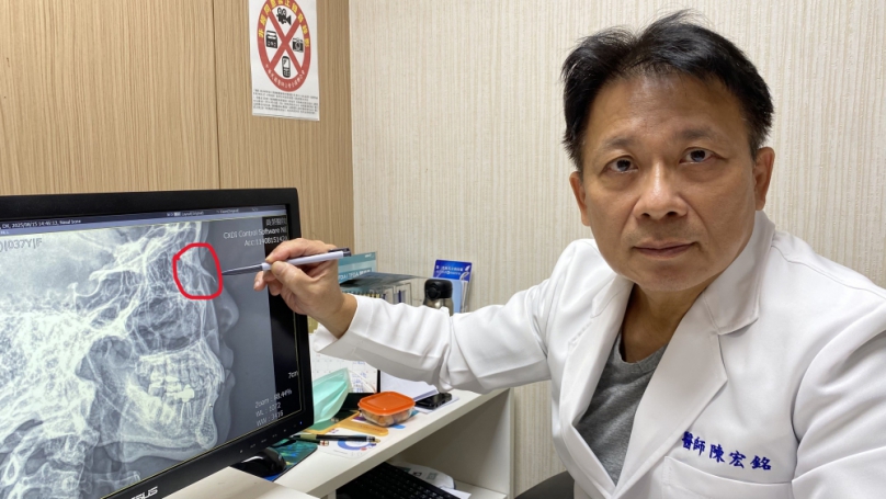 2歲兒子衝斷媽媽鼻骨（圓圈處），員榮醫院整型外科手術復原。（照片員榮提供）