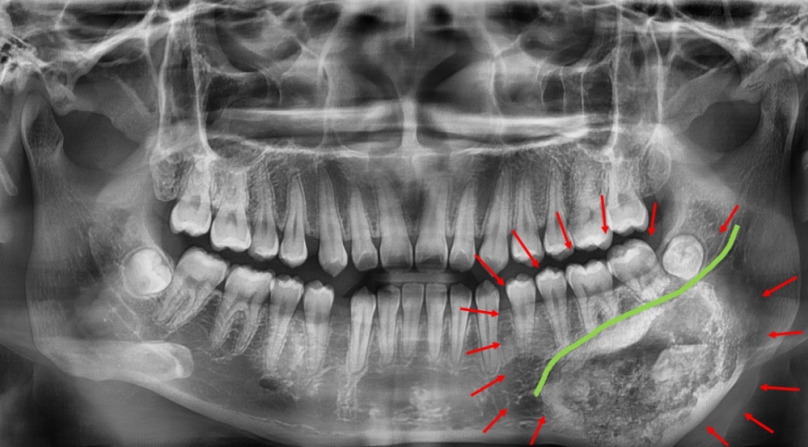 18歲黃女下顎膨脹等症狀，經秀傳醫院檢查罹患罕見「齒源性腫瘤」（牙骨質骨化纖維瘤）。（照片秀傳提供）