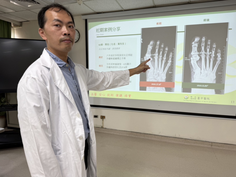 愛登山卻被拇指外翻困擾 醫師提醒這些症狀別拖延治療