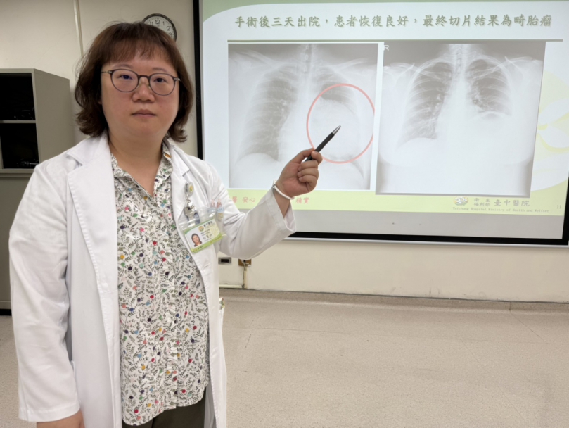 毫無症狀竟藏15公分腫瘤!臺中醫院提醒:定期健檢及早揪出胸腔病灶