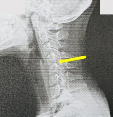 長期低頭滑手機，頸椎呈現滑脫情況（箭頭指處）。（照片員榮提供）