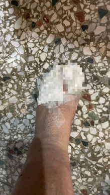 忙救災又ㄧ個重傷｜雙腳長期浸泡在泥濘中，光復村長聯誼會長徐振雄，10個腳指頭都磨破快見骨，疑罹患蜂巢性組織炎，病情相當嚴重就醫中！