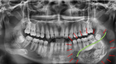 18歲黃女下顎膨脹等症狀，經秀傳醫院檢查罹患罕見「齒源性腫瘤」（牙骨質骨化纖維瘤）。（照片秀傳提供）