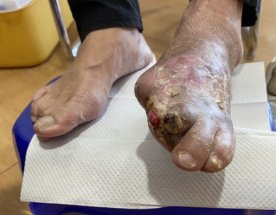 有糖尿病史，李姓婦人左腳腳趾傷口惡化而切除大拇趾和食趾。（照片員榮提供）