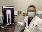 40年前骨折後遺症下肢變形  七旬翁雙膝矯正成功擺脫O型腿