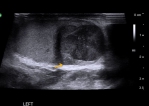 左腰痛和血尿，32歲男子經泌尿科醫師診斷﹁睪丸癌末期﹂（箭頭指處）。（照片楊旻鑫醫師提供）